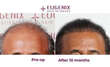 Eugenix Hair Transplant Clinic | NW 7 | 6309 Grafts | 10 Months Post-op| Dr. Pradeep Sethi