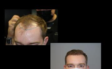 PANINE, MD | Chicago Hair Transplant Clinic | FUE Hair Transplant with 2,521 Grafts At 6 Months