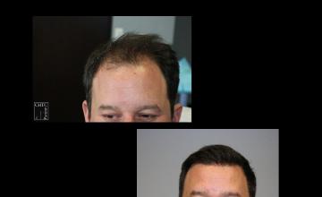 PANINE, MD | Chicago Hair Transplant Clinic | FUE Hair Transplant Results with 2,663 Grafts