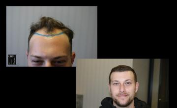 PANINE, MD | Chicago Hair Transplant Clinic | 2 FUE Hair Transplants with 4,736 Grafts