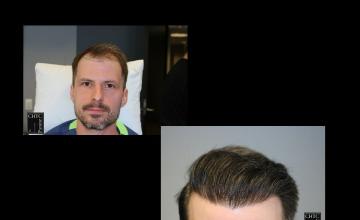 PANINE, MD | CHICAGO HAIR TRANSPLANT CLINIC | Results of FUE Hair Transplant with 2,500 Grafts After One Year