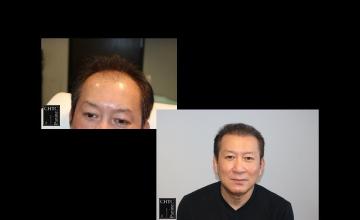 PANINE, MD | Chicago Hair Transplant Clinic | 2,500 Graft FUE Hair Transplant at 7 Months Post-Op