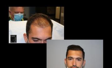 PANINE, MD | Chicago Hair Transplant Clinic - FUE Hair Transplant with 2,523 Grafts at 7 Months Post-Op