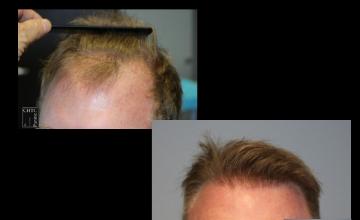 PANINE, MD | Chicago Hair Transplant Clinic - FUE Hair Transplant Results with 2,586 Grafts at 1 Week and 9 Months Post-Op