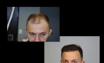 PANINE, MD | Chicago Hair Transplant Clinic | FUE Hair Transplant with 2,550 Grafts at 7 Months Post-Op