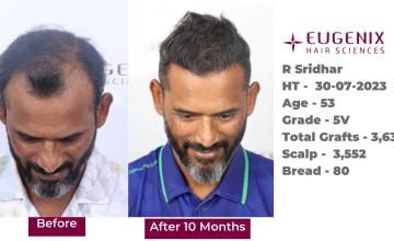 Eugenix Hair Sciences | NW 5V | 3,632 Grafts | 10 Months Hair Transplant Results| Dr. Pradeep Sethi