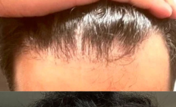 3200 grafts for entire scalp with Dr. Felicidad Espinosa