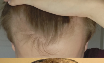 Dr. Felicidad Espinosa - 2070 grafts - 22 year old patient