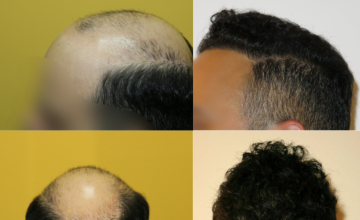 Dr. Zarev 7070 + 3613 grafts