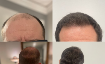 Dr. Zarev - 7700 Grafts