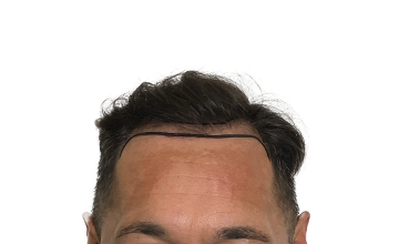 Dr Matt Egan - 2,668 Grafts | FUE | Hairline and Crown | 12 Months