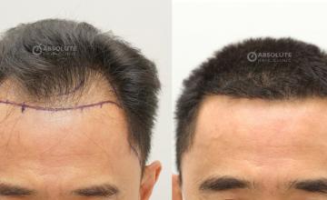 Dr. Kongkiat Laorwong, MD, FISHRS,  hairline FUE 2540 grafts, 7 months post op