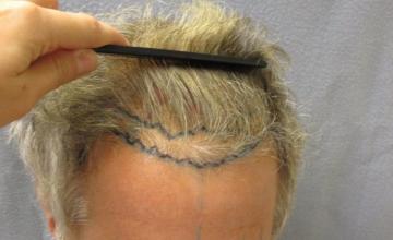 Hair Transplant results for Dr. Nusbaum and Dr. Rose