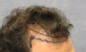 Hair Transplant surgery Dr. Rose