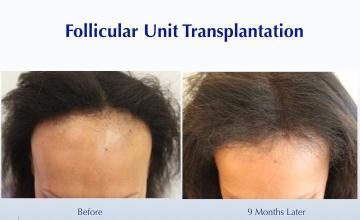 Female African-American Hairline Advancement (1935 FUT grafts): Carlos K. Wesley, M.D. (NYC & LA)