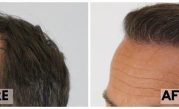 FUE Hair Transplant - 2661 Grafts in 1 Session - Dr. Rahal