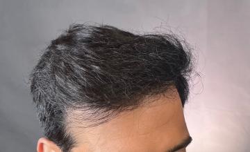 Dr. Arocha | 2700 Graft FUE | 9 month results