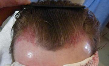 Dr Carman Temporal Recession Hairline Reconstruction