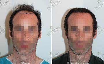 Case performed by Dr. Feriduni – 4109 FU in 1 procedure