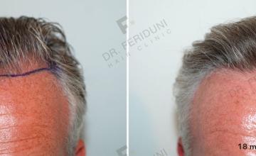 Cases on hairline design performed by Dr. Feriduni