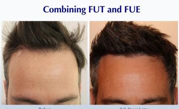 #BAM Most Natural Hairline (2277 FUE and FUT grafts): Carlos K. Wesley, M.D. (NYC & LA)