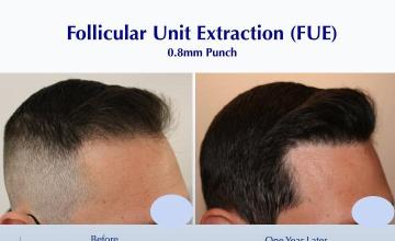 #BAM Healthy and Natural Hairline (2445 grafts): Carlos K. Wesley, M.D. (NYC & LA)