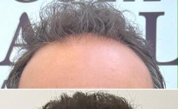 2415 grafts with Bogota Hairlines (Dr Camacho) DEC 2021