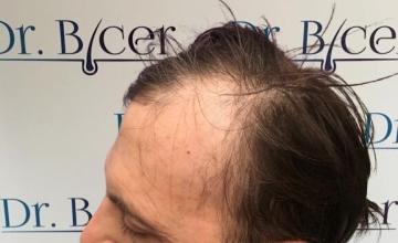 Ozlem Bicer MD-Hair Transplant-3650 Grafts FUE by micro-motor, 8. months result