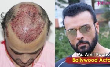 Celebrity Actor Mr. Amit Pachori Hair Transplant at Medispa - 4700 Grafts, Combine FUT + FUE, NW VII