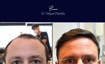 Dr. Pittella • Norwood 6, Straight hair, Good donor: SOLVED