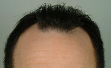1 year followup, one session, 2447 grafts/4728 hairs FUT- Robert Haber, MD