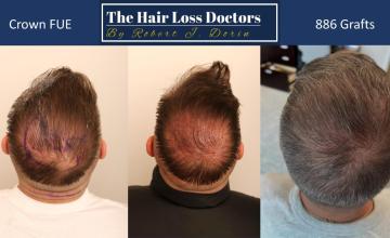 Dr. Robert Dorin ~ Patient Submission -  Crown FUE