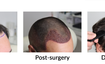 Dr. Espinosa Custodio (Spain and Mexico) - 3,452 grafts - FUE/DHI Hair Transplant