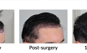 Dr. Espinosa Custodio (Spain and Mexico) - 1,713 grafts - FUE/DHI Hair Transplant