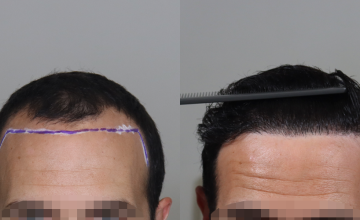 Dr. Espinosa Custodio - 2597 grafts - FUE Hair Transplant
