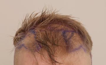 Dr. Robert Dorin ~ Frontal FUE ~ Early risers!