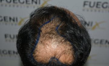 Dr. Munib Ahmad - How to cover one corner of hairline + midscalp + crown with 2490g in a single session - Black Hair - FueGenix - The Netherlands