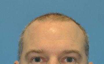 Michael Vories, MD 4000 FUE Grafts