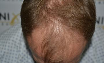 Dr. Munib Ahmad - 2430g - Conservative yet youthfull hairline transplant  - Blond Hair - FueGenix - The Netherlands [EXTREME CLOSE UPS]