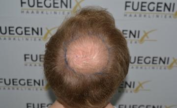 Dr. Munib Ahmad - 1900g - Blond Crown Regrown - FueGenix - The Netherlands