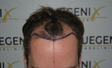 Dr. Munib Ahmad - The Henry Cavill Hairline - Dark Brown Hair - FueGenix - The Netherlands