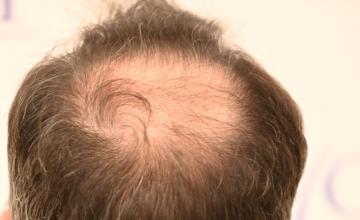 Ozlem Bicer MD-Hair Transplant-3870 Grafts FUE by micro-motor, 5. months result
