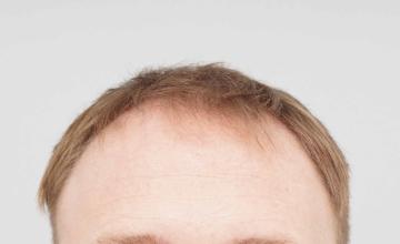 Dr B Farjo 3870g FUE in two procedures three years apart.