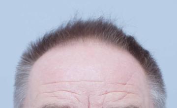 Dr B Farjo 2184g FUE (Front and top)