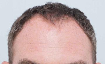 Dr B Farjo 2100g FUE (Front and crown tweak)