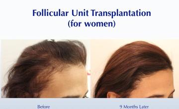 Female Hairline Restoration (1681 FUT grafts): Carlos K. Wesley, M.D. (NYC & LA)