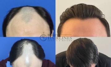 Bogota Hairlines -  BYE BYE Hair system, 2 surgeries 4425 grafts, Dr Sergio Camacho