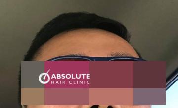 Dr. Kongkiat Laorwong, MD, FISHRS,  Full Beard FUE 4000 grafts, 2 sessions