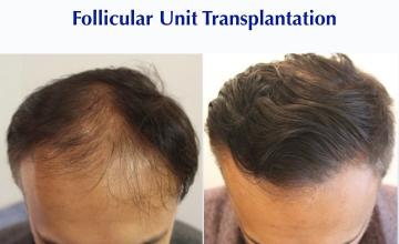 Benefit of Minimal Color Contrast (2224 FUT grafts): Carlos K. Wesley, M.D. (NYC & LA)