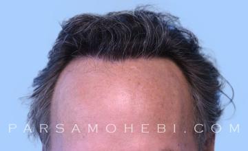 61 Year Old Male with Class IV Hair Loss by Dr. Parsa Mohebi